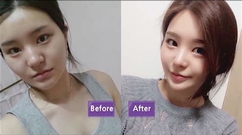 best korean plastic surgery.